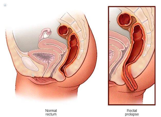 Prolapso Rectal vs. Hemorroides: Diferencias Clave y Síntomas - Cómo saber si es prolapso o hemorroides hemorroides prolapsadas - Cómo saber si es prolapso o hemorroides