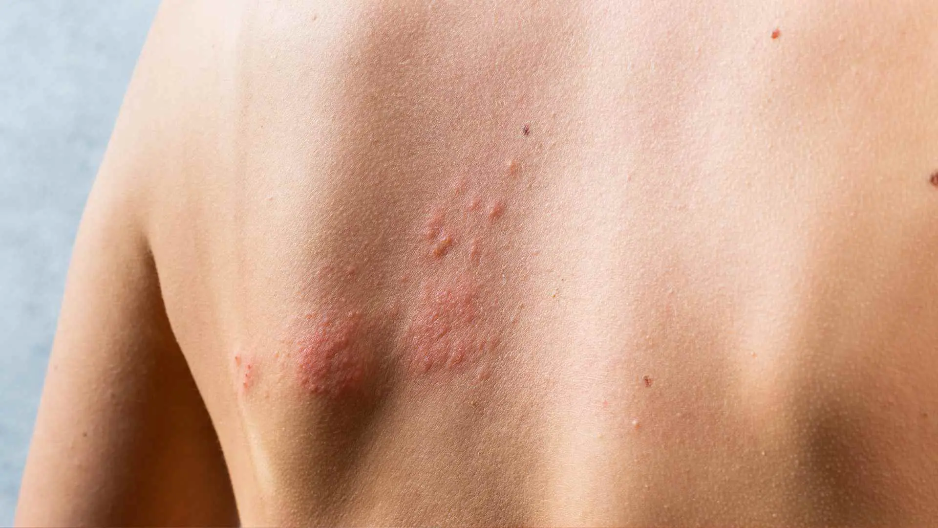 Rash Cutáneo: Causas, Síntomas y Tratamiento - Cómo saber si es rash rash cutaneo causas - Cómo saber si es rash
