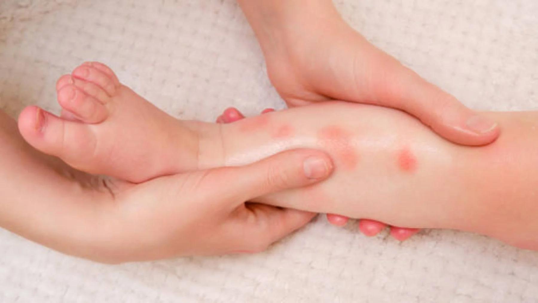 Manchas Rojas en la Piel de Niños: ¿Alergia o Sarpullido? - Cómo saber si es sarpullido o alergia en niños manchas rojas en la piel niños - Cómo saber si es sarpullido o alergia en niños