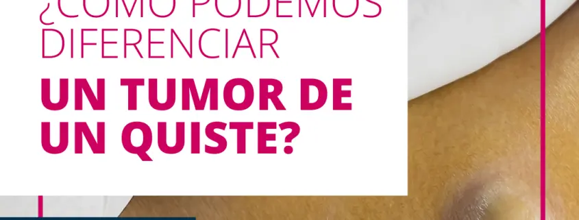 Diferencia entre Quiste y Tumor: Una Guía Completa - Cómo saber si es un tumor diferencia entre quiste y tumor - Cómo saber si es un tumor