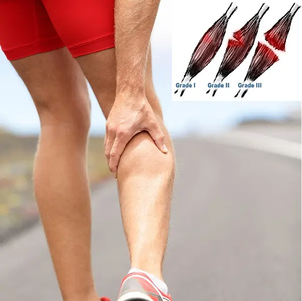 Desgarro Muscular en la Pierna: Cómo Identificarlo, Tratarlo y Prevenirlo - Cómo saber si es una contractura o desgarro desgarro muscular pierna - Cómo saber si es una contractura o desgarro