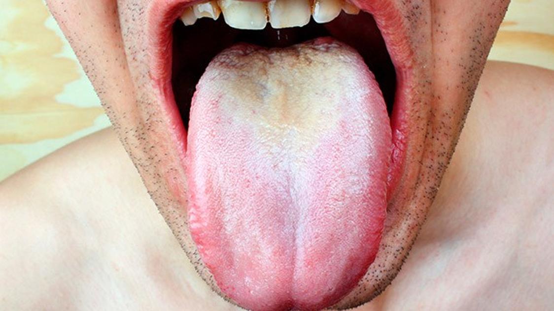 Aftas en la boca por VIH: Síntomas, etapas y tratamiento - Cómo saber si la boca seca es por VIH aftas por vih - Cómo saber si la boca seca es por VIH