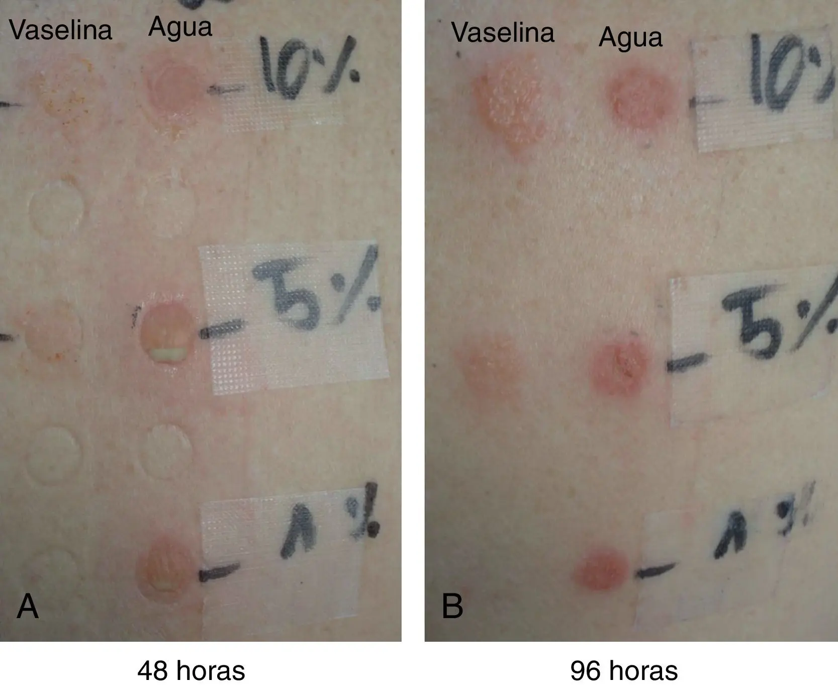 Prueba de Alergia al Yodo: Detectando Sensibilidades al Contraste - Cómo saber si soy alérgico al contraste test de alergia al yodo - Cómo saber si soy alérgico al contraste