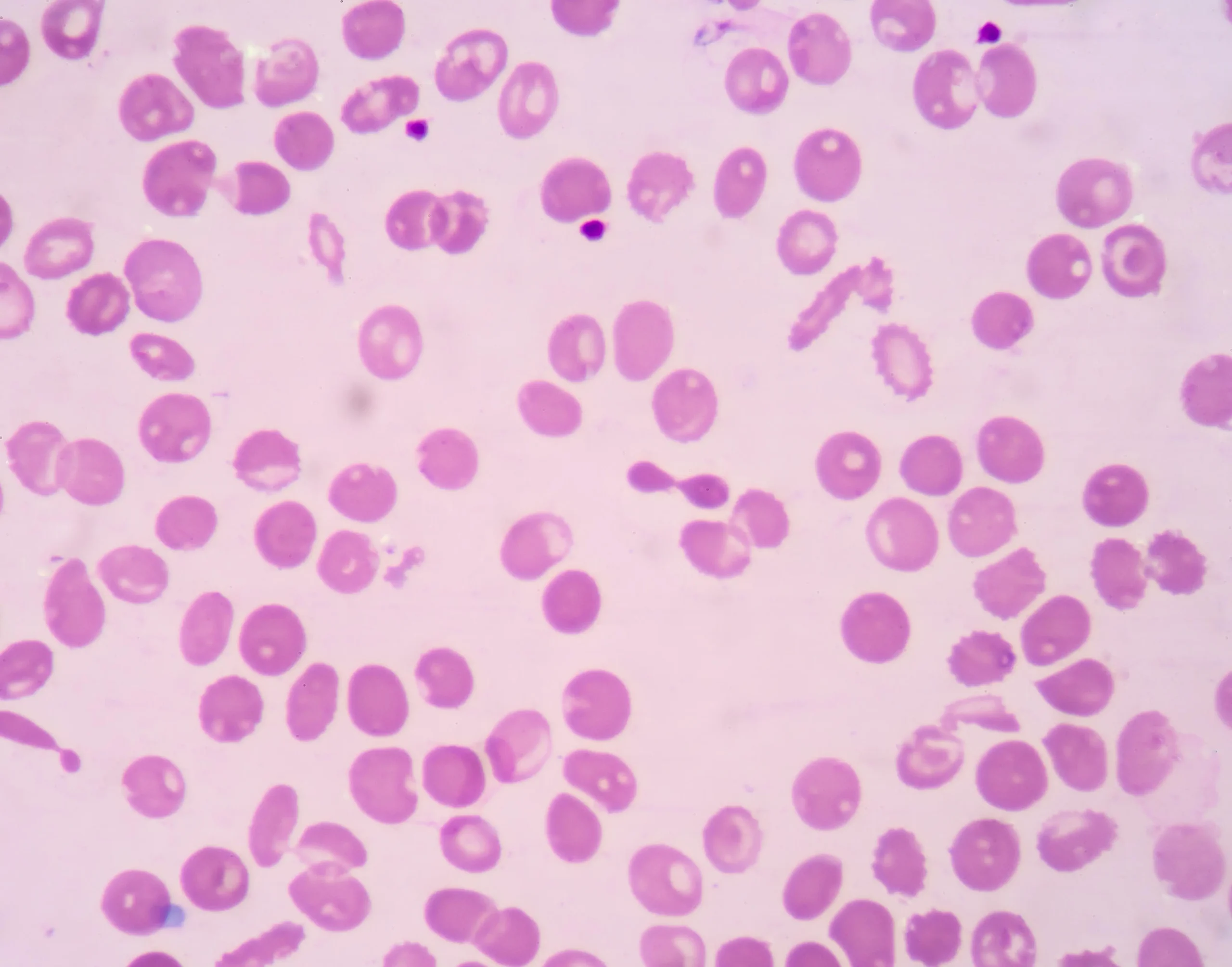Beta Talasemia: Causas, Síntomas, Diagnóstico y Tratamiento - Cómo saber si tengo beta talasemia beta talasemia - Cómo saber si tengo beta talasemia