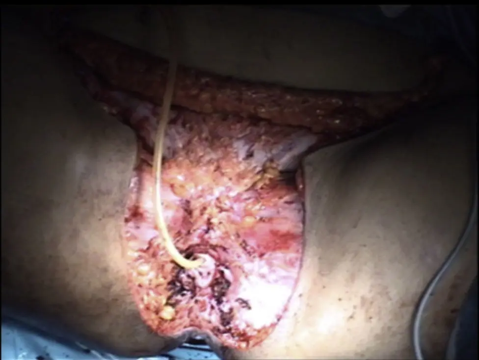 Cáncer Vulvar en Mujeres Jóvenes: Una Mirada a la Realidad - Cómo saber si tengo cáncer de Bartholin cancer vulvar en mujeres jovenes - Cómo saber si tengo cáncer de Bartholin