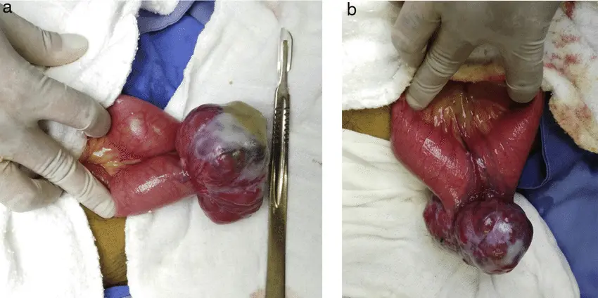 Tumor en el Intestino: Diagnóstico, Tratamiento y Todo lo que Necesitas Saber - Cómo saber si tengo cáncer en el intestino delgado tumor en el intestino - Cómo saber si tengo cáncer en el intestino delgado