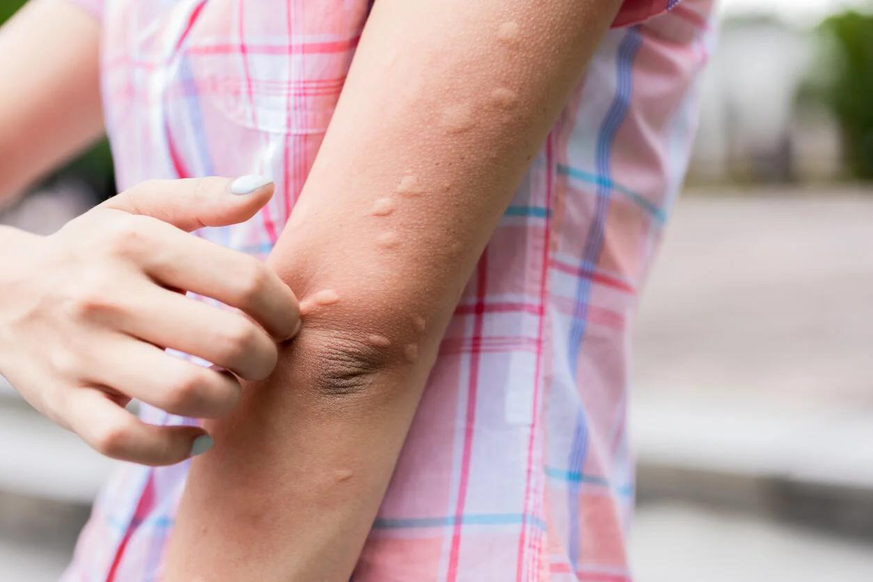 Sarpullido en los Brazos por Estrés: Causas, Tratamientos y Consejos - Cómo saber si tengo dermatitis nerviosa sarpullido en los brazos por estres - Cómo saber si tengo dermatitis nerviosa