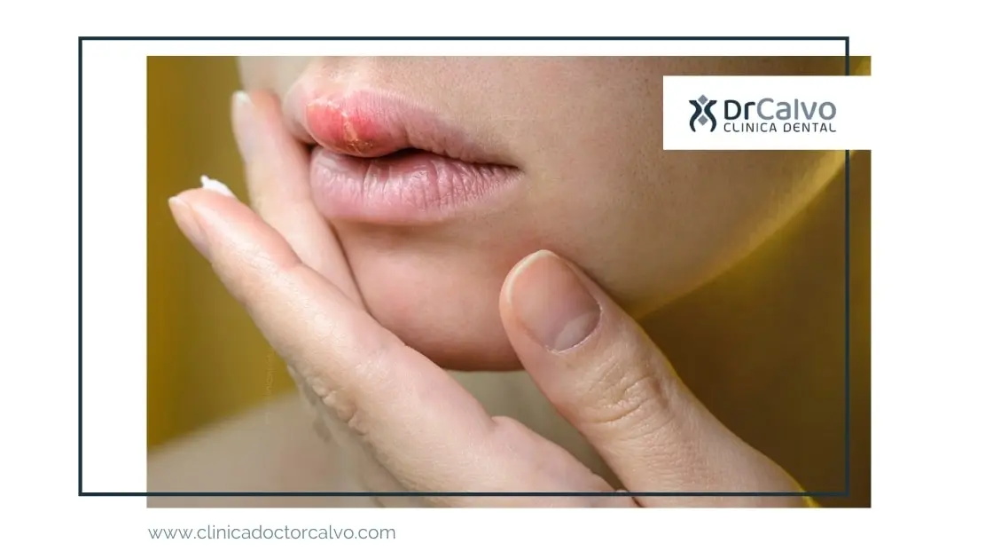 Herpes Labial por Estrés: Causas, Síntomas y Tratamiento - Cómo saber si tengo herpes por estrés herpes labial por estres - Cómo saber si tengo herpes por estrés