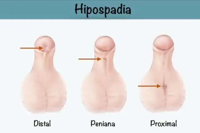 Hipospadias: Causas, Diagnóstico y Tratamiento - Cómo saber si tengo hipospadia hipospadia - Cómo saber si tengo hipospadia