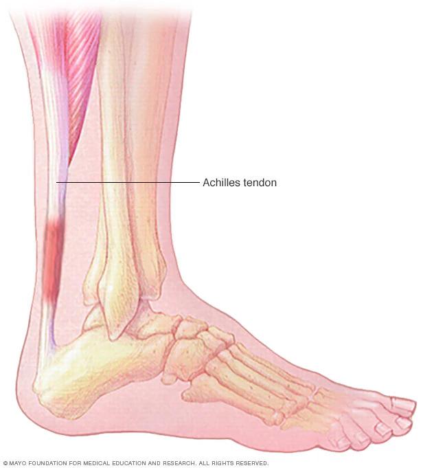 dolor en el tendon de aquiles - Cómo saber si tengo lesionado el tendón de Aquiles
