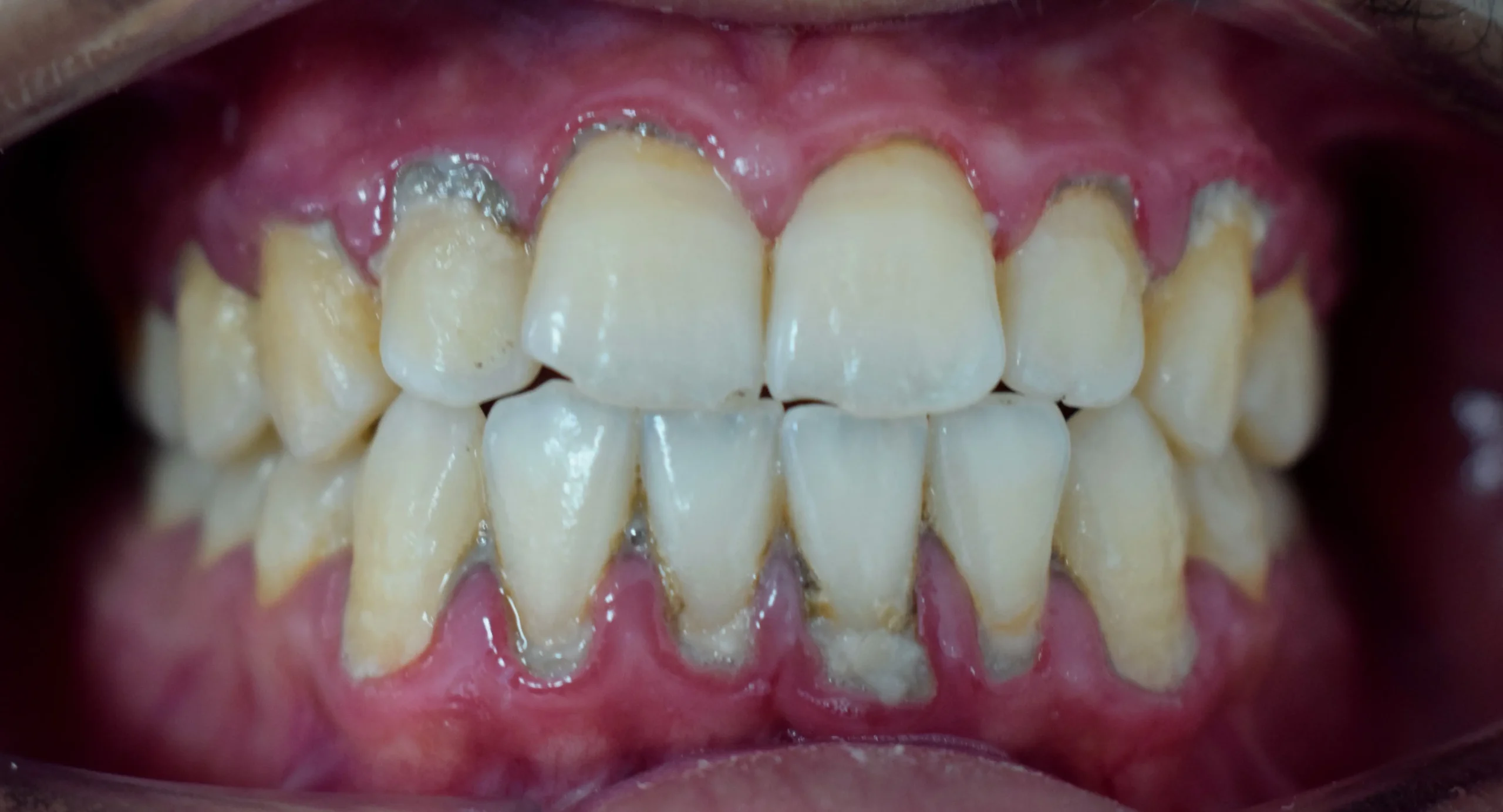 Placa Bacteriana: Causas, Efectos y Cómo Prevenirla - Cómo saber si tengo placa bacteriana en los dientes dientes con placa bacteriana - Cómo saber si tengo placa bacteriana en los dientes