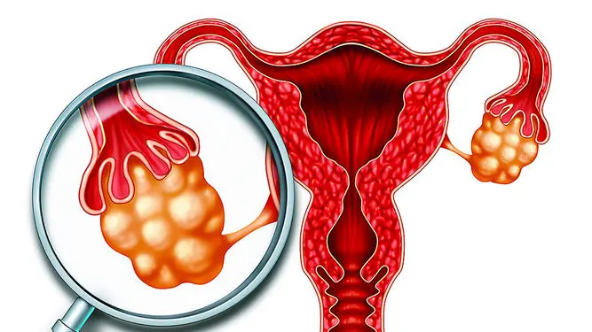 Quistes de Ovario: Todo lo que Necesitas Saber - Cómo saber si tengo quistes en los ovarios sin ir al médico como son los quistes de ovario - Cómo saber si tengo quistes en los ovarios sin ir al médico