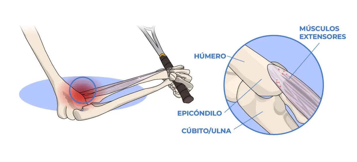 Codo de tenista: causas, síntomas, tratamiento y prevención - Cómo saber si tienes codo de tenista codo de tenista - Cómo saber si tienes codo de tenista