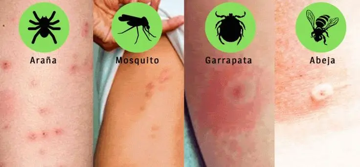 Picaduras de garrapata en niños: qué debes saber sobre la enfermedad de Lyme y cómo prevenirla - Cómo saber si un niño tiene la enfermedad de la garrapata picadura de garrapata en niños - Cómo saber si un niño tiene la enfermedad de la garrapata