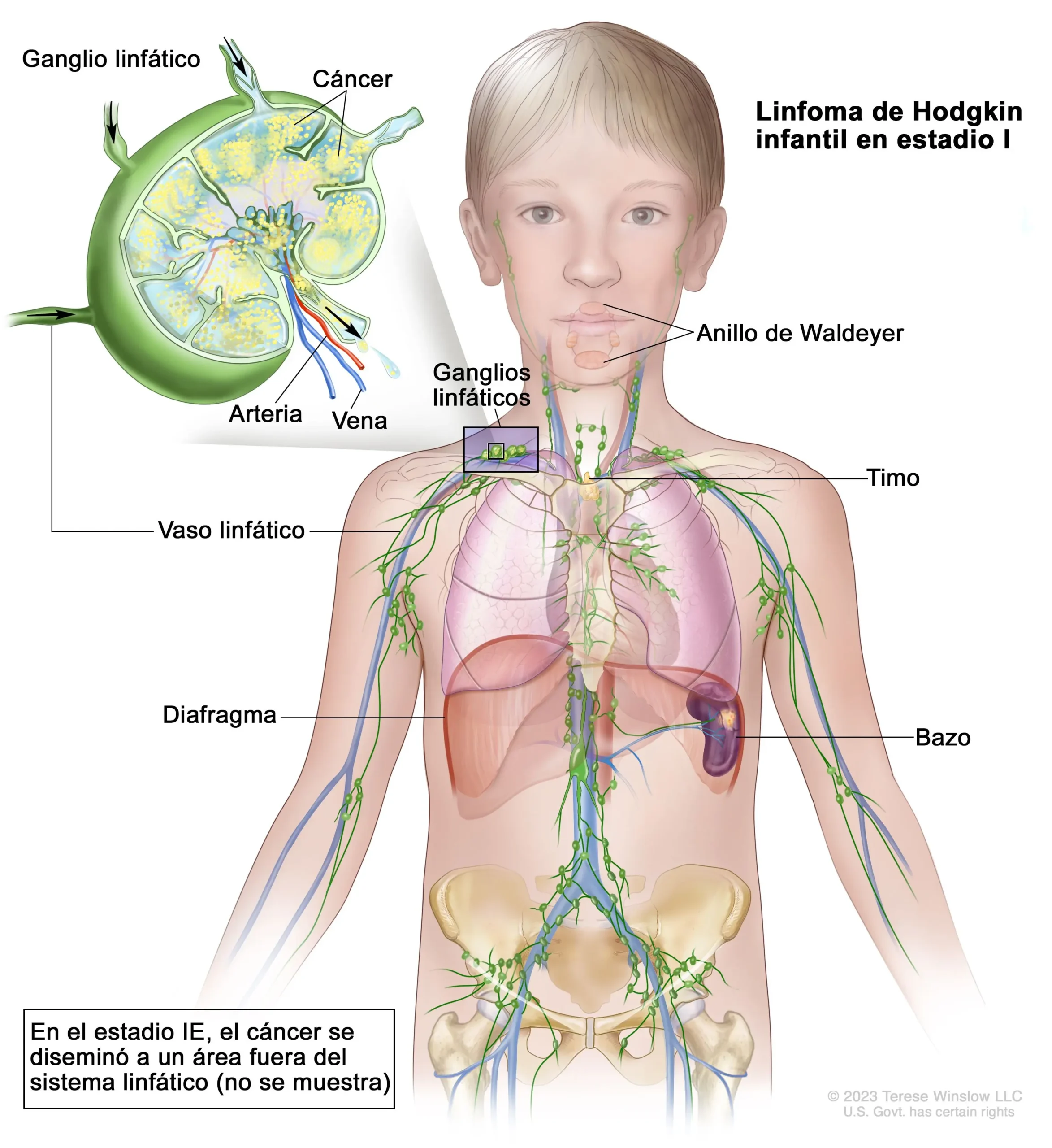 Linfoma de Hodgkin en Niños: Diagnóstico, Síntomas y Tratamiento - Cómo saber si un niño tiene linfoma linfoma de hodgkin en niños - Cómo saber si un niño tiene linfoma