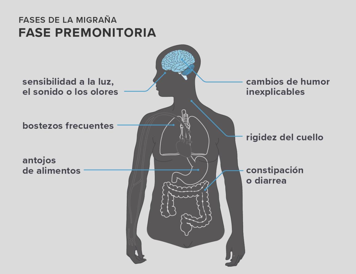 Migraña Ocular: Síntomas, Causas y Tratamiento - Cómo se alivia la migraña ocular sintomas de migraña ocular - Cómo se alivia la migraña ocular