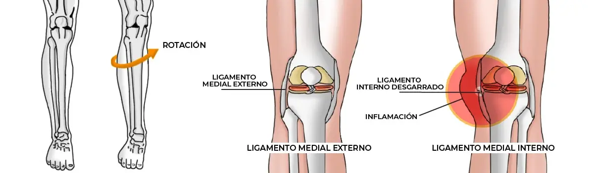 Ligamentos de la Rodilla: Cómo Curarlos y Recuperarse - Cómo se arreglan los ligamentos de la rodilla ligamentos de la rodilla como curar - Cómo se arreglan los ligamentos de la rodilla