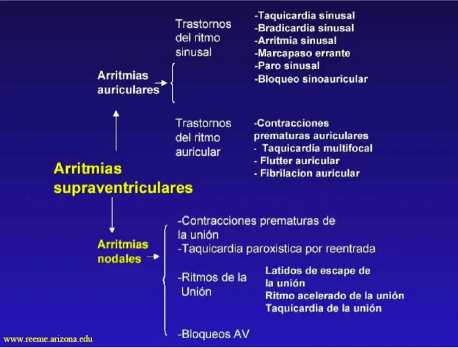 Clasificación de las Arritmias: Una Guía Completa - Cómo se clasifican las arritmias clasificacion de arritmias - Cómo se clasifican las arritmias