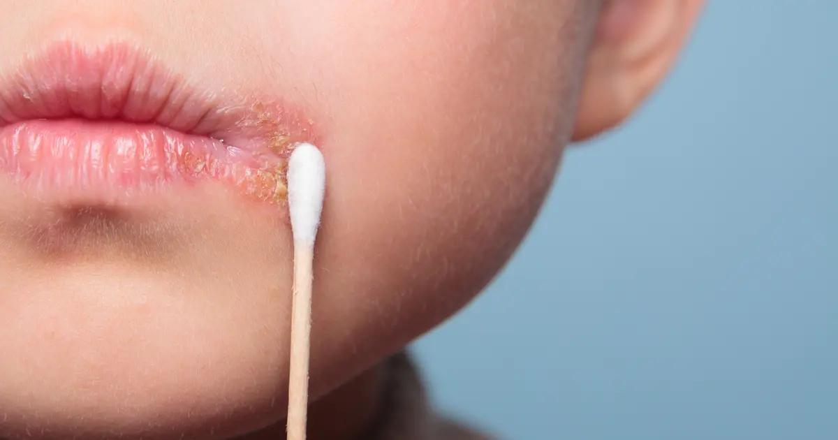 herpes en bebes - Cómo se contagia el herpes en niños
