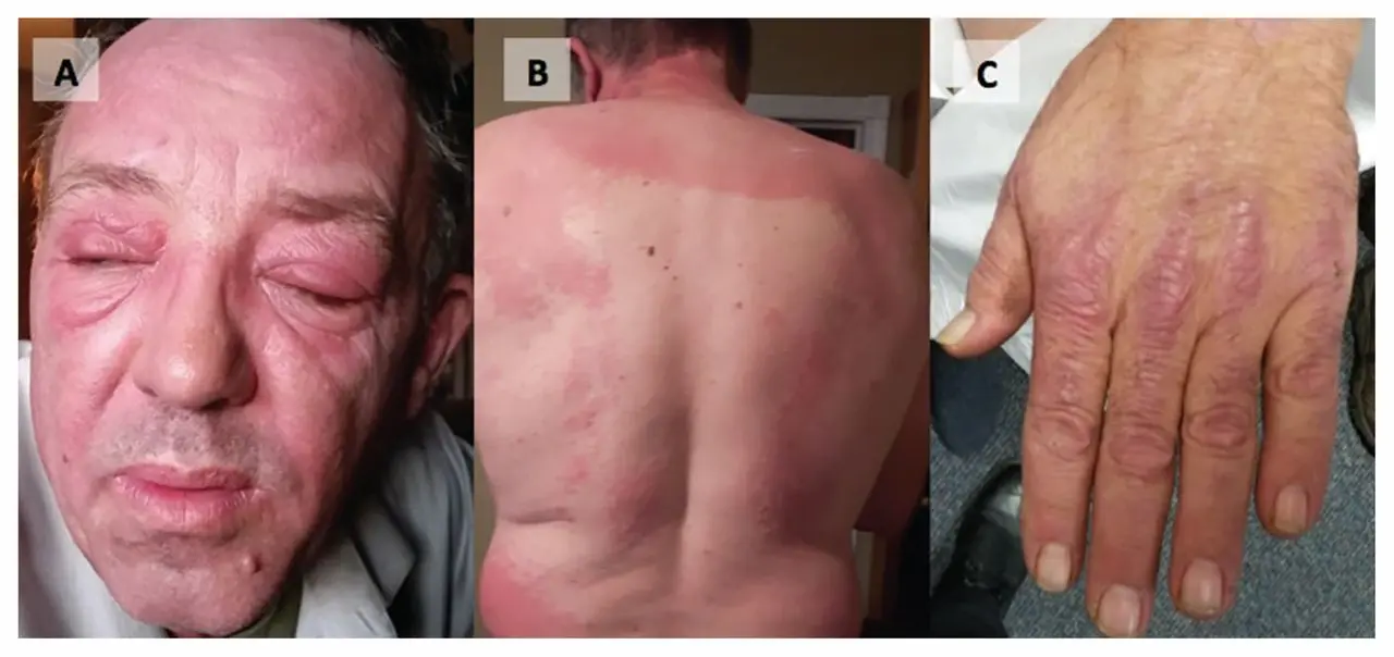 Dermatopolimiositis: Una enfermedad autoinmune que afecta a niños y adultos - Cómo se contagia la dermatomiositis dermatopolimiositis - Cómo se contagia la dermatomiositis
