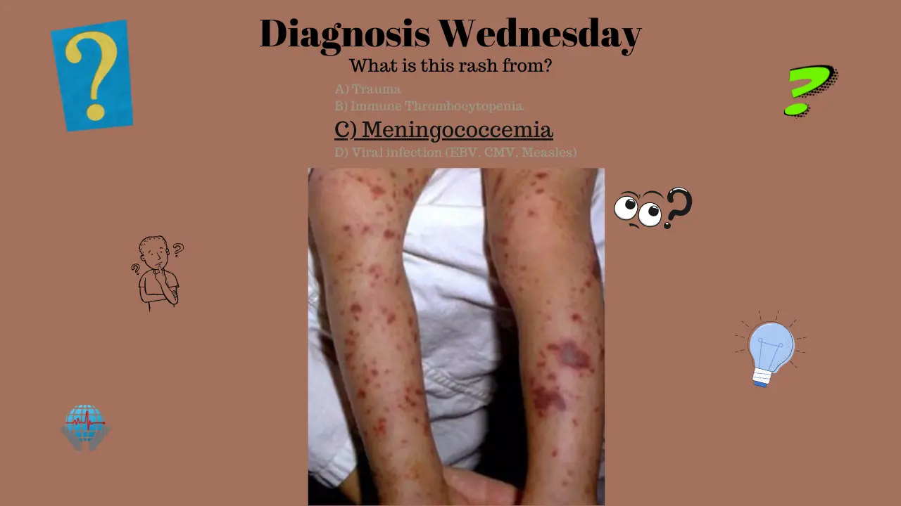 Meningococcemia: Una guía completa sobre la infección bacteriana - Cómo se contagia la meningitis meningocócica meningococcemia - Cómo se contagia la meningitis meningocócica