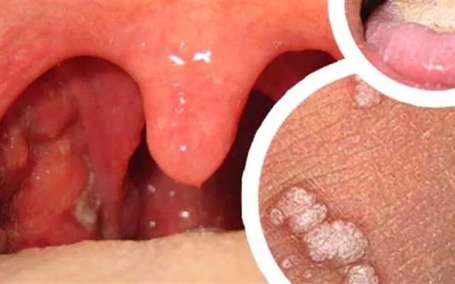 Papilomatosis laríngea: Contagio, síntomas y tratamiento - Cómo se contagia la papilomatosis laringea verrugas en la garganta - Cómo se contagia la papilomatosis laringea