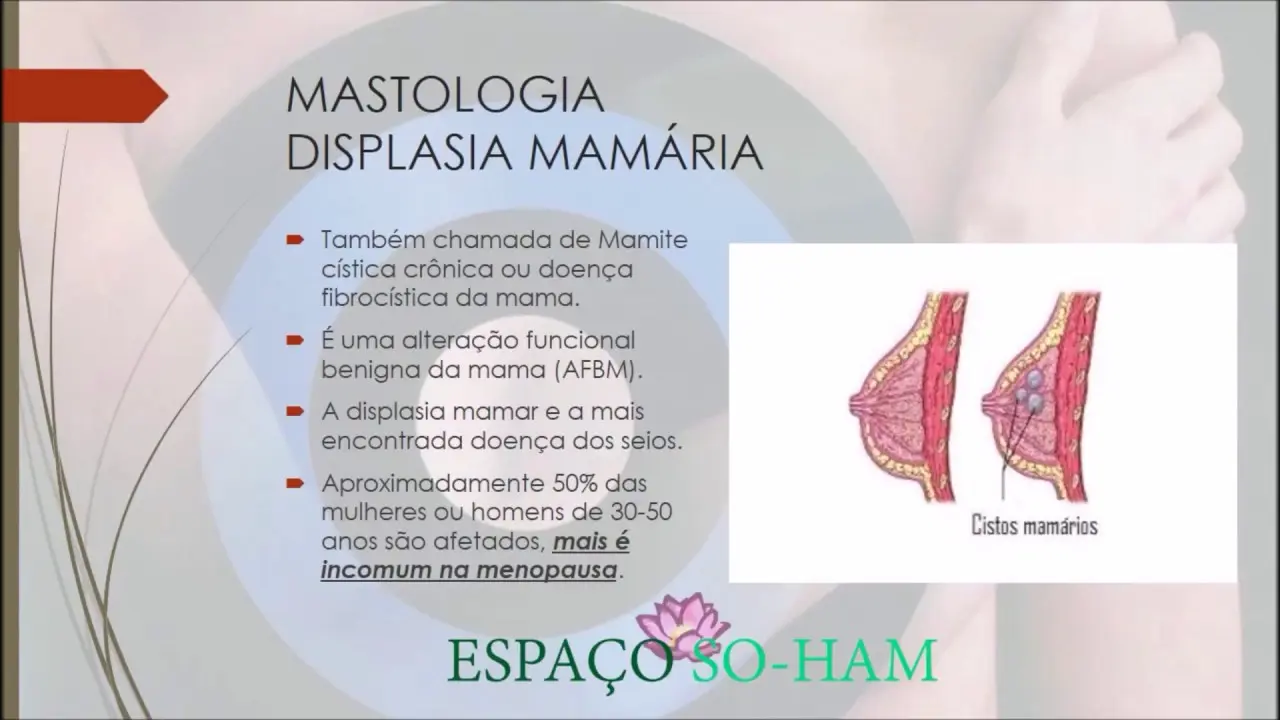 Displasia Mamaria: Causas, Síntomas y Tratamiento - Cómo se corrige la displasia mamaria displasia mamaria - Cómo se corrige la displasia mamaria