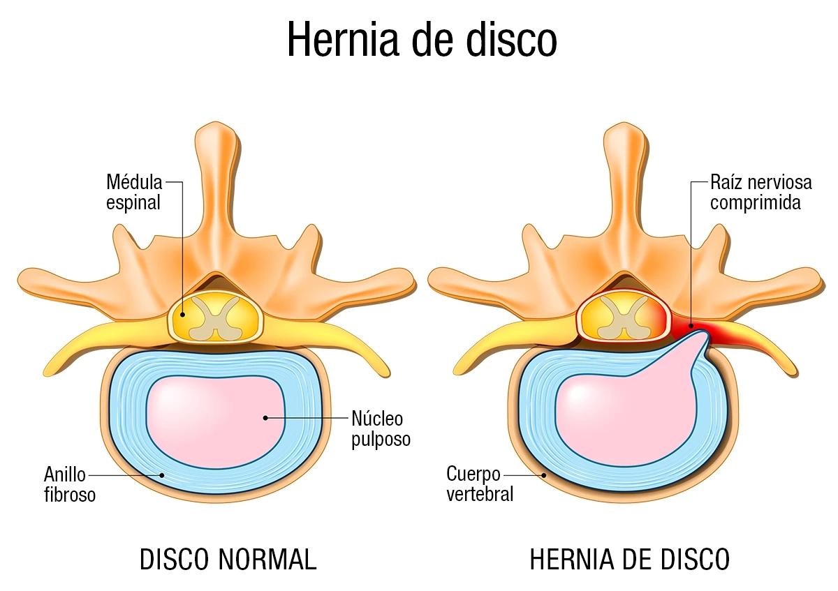 Hernia de Disco: Causas, Síntomas y Tratamientos - Cómo se corrige una hernia de disco hernias de disco - Cómo se corrige una hernia de disco