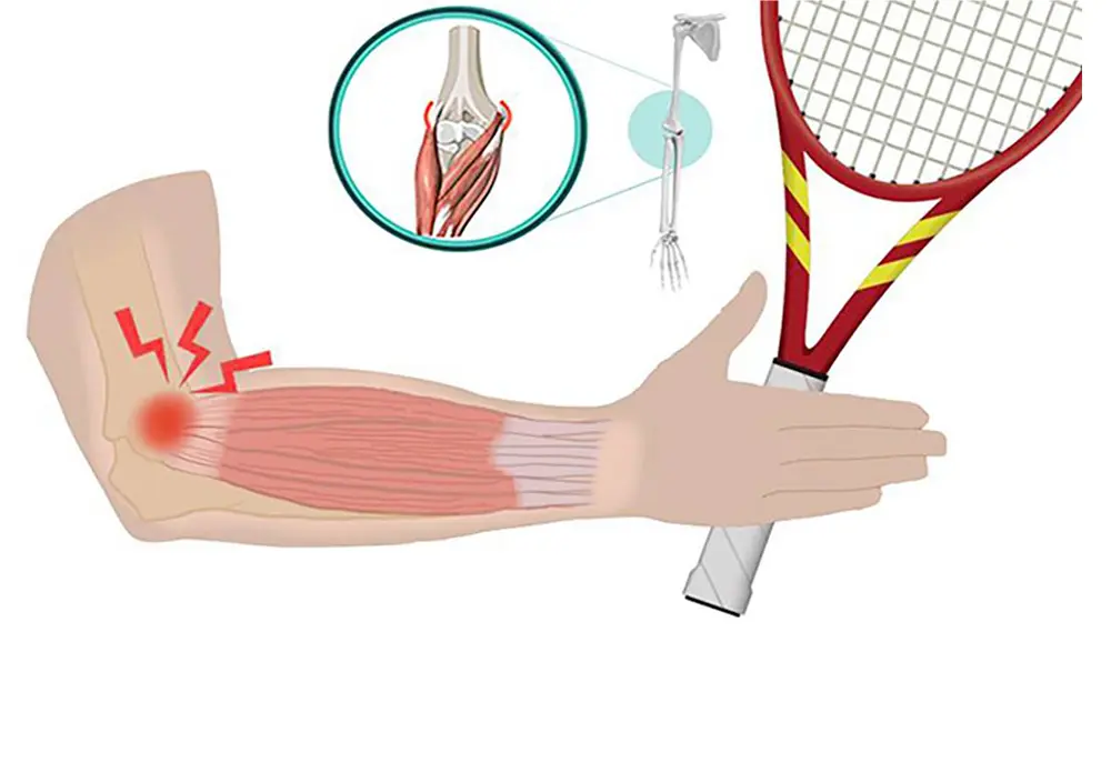 Codo de tenista: causas, síntomas, tratamiento y prevención - Cómo se cura el dolor del codo del tenista codo de tenista - Cómo se cura el dolor del codo del tenista