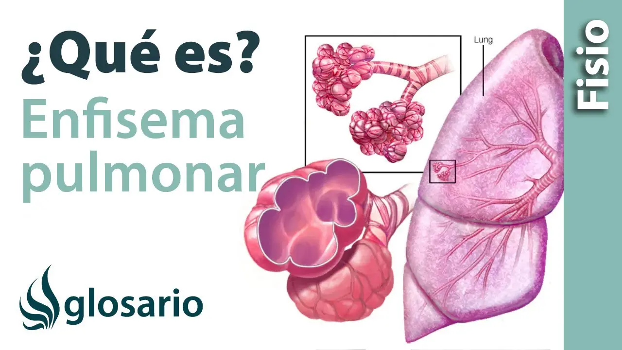 Enfisema Pulmonar: Causas, Síntomas, Prevención y Tratamiento - Cómo se cura el enfisema pulmonar que es enfisema - Cómo se cura el enfisema pulmonar