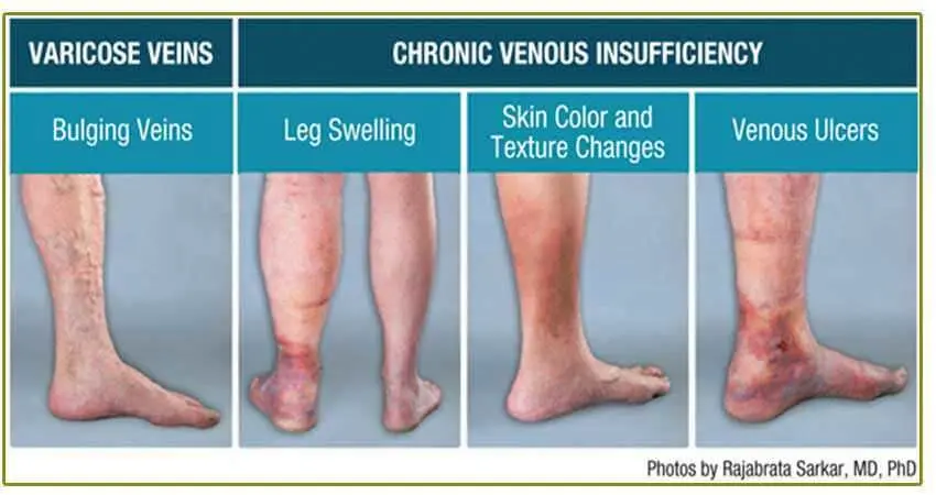 Dermatitis por estasis: causas, síntomas, tratamiento y prevención - Cómo se cura la estasis venosa estasis venosa - Cómo se cura la estasis venosa