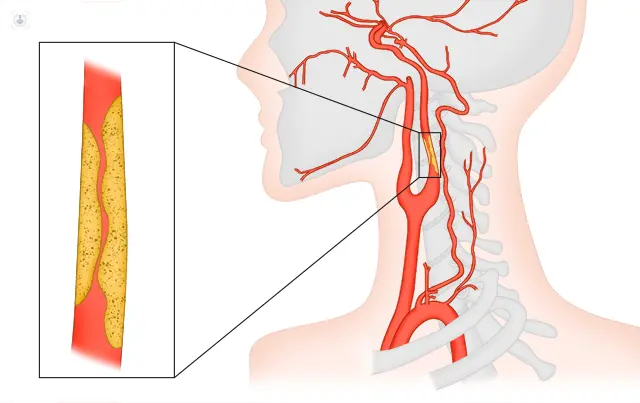 Estenosis Arterial: Causas, Síntomas, Diagnóstico y Tratamiento - Cómo se cura la estenosis de la arteria renal estenosis arterial - Cómo se cura la estenosis de la arteria renal