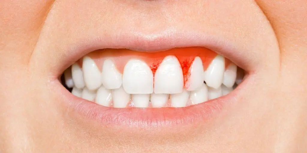 Gingivitis: Causas, síntomas y tratamiento para encías sanas - Cómo se cura la gingivitis en las encías encias con gingivitis - Cómo se cura la gingivitis en las encías