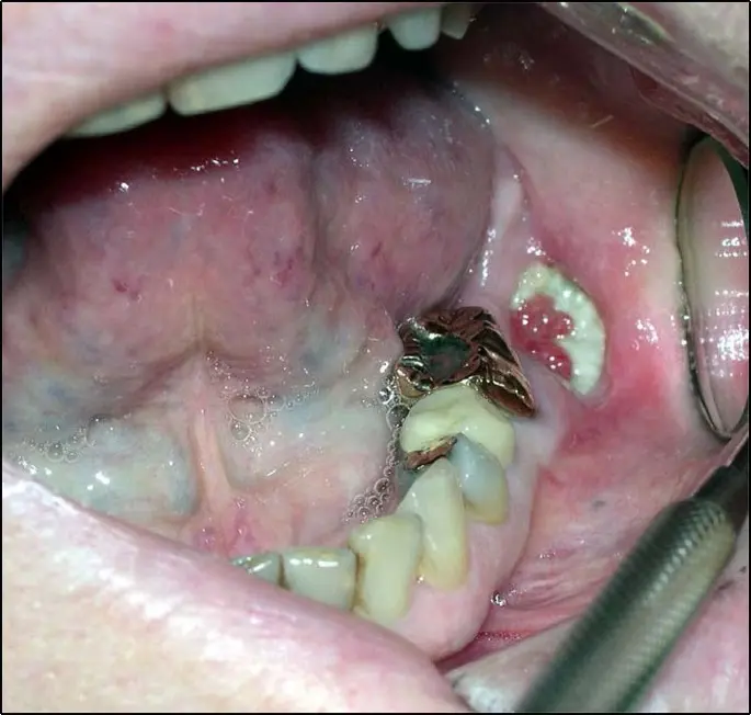 Osteonecrosis Mandibular: Causas, Síntomas y Tratamiento - Cómo se cura la osteonecrosis mandibular osteonecrosis mandibular - Cómo se cura la osteonecrosis mandibular