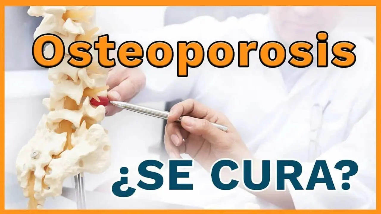 la osteoporosis tiene cura - Cómo se cura la osteoporosis avanzada