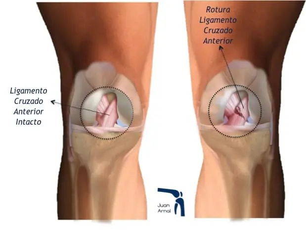Cómo se cura la rotura del ligamento cruzado anterior: guía completa - Cómo se cura la rotura del ligamento cruzado anterior rotura lca - Cómo se cura la rotura del ligamento cruzado anterior