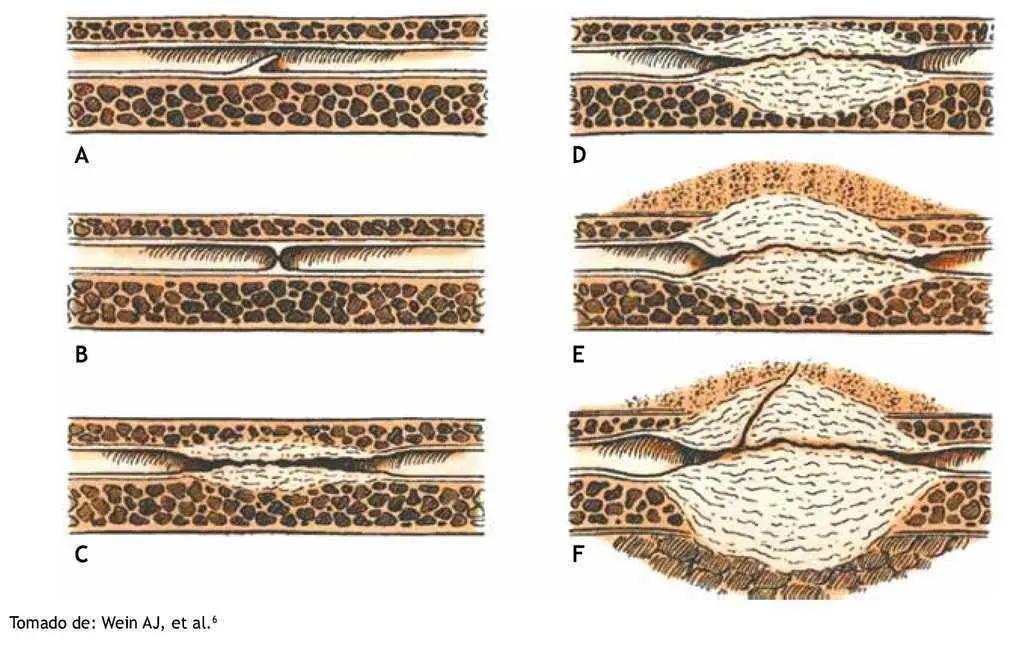 Estenosis de uretra: causas, síntomas, tratamiento y recuperación - Cómo se cura una estenosis de uretra estenosis de uretra - Cómo se cura una estenosis de uretra