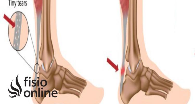 Tendinosis: Causas, Síntomas, Tratamiento y Prevención - Cómo se cura una tendinosis que es tendinosis - Cómo se cura una tendinosis
