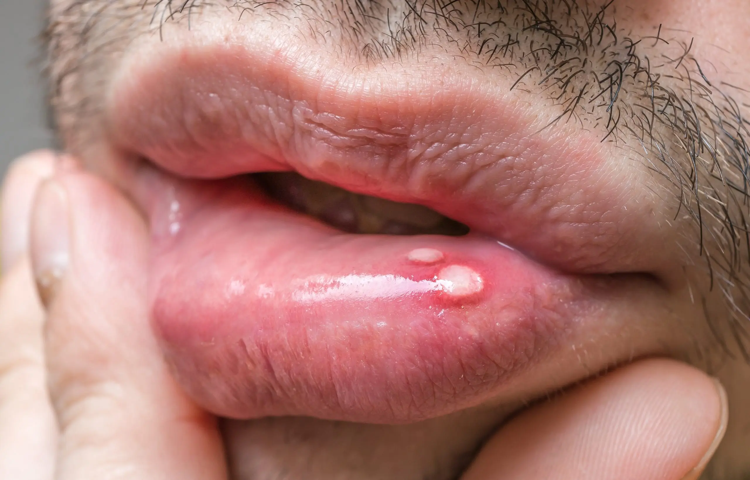 Verrugas en los labios: Causas, síntomas y tratamiento - Cómo se cura una verruga en el labio verrugas en los labios - Cómo se cura una verruga en el labio