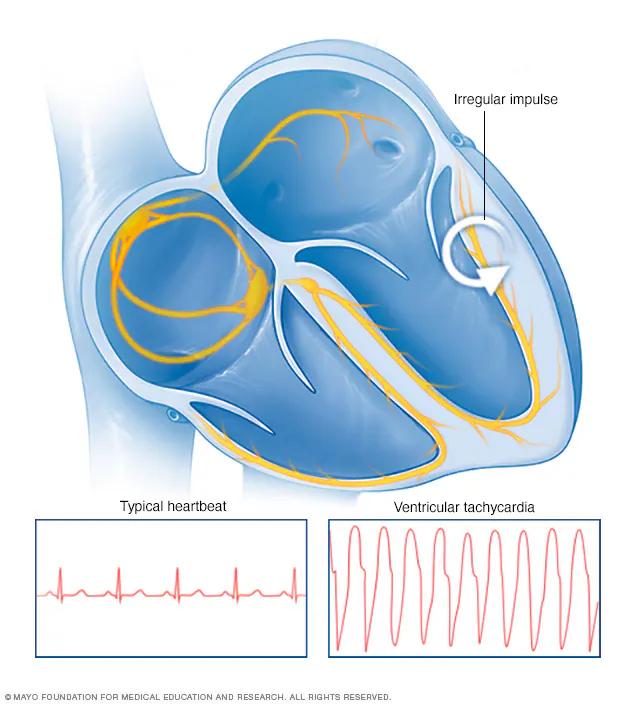 Taquicardia Ventricular: Causas, Diagnóstico y Tratamiento - Cómo se detecta la taquicardia ventricular taquicardia ventricular - Cómo se detecta la taquicardia ventricular