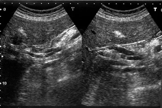 Ecografía Abdominal: Una Herramienta Clave para Detectar Tumores - Cómo se detecta un tumor en el abdomen ecografía abdominal detecta tumores - Cómo se detecta un tumor en el abdomen