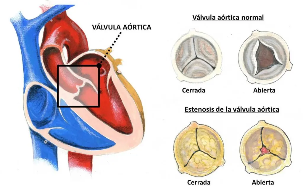 Estenosis Valvular Aórtica: Diagnóstico, Tratamiento y Estilo de Vida - Cómo se diagnostica la estenosis aórtica estenosis valvular aortica - Cómo se diagnostica la estenosis aórtica