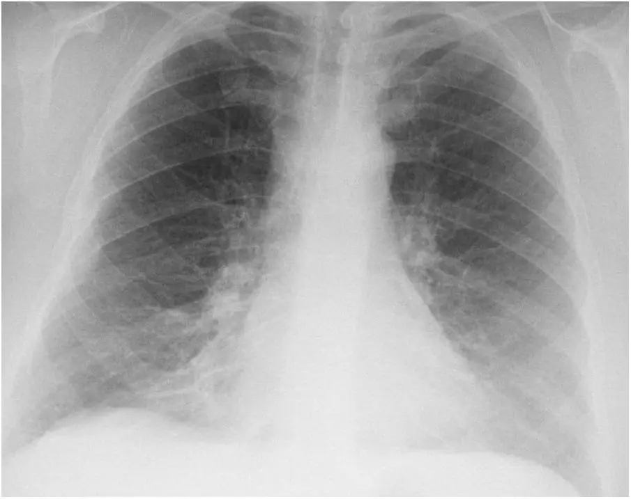 Neumonitis Química: Diagnóstico, Síntomas y Tratamiento - Cómo se diagnostica la neumonitis neumonitis quimica - Cómo se diagnostica la neumonitis