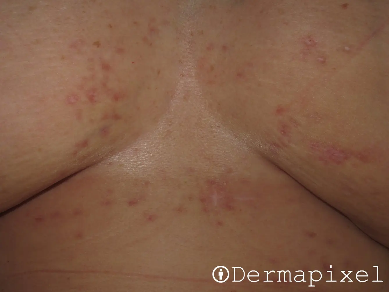 Liquen Escleroso: Causas, Síntomas, Diagnóstico y Tratamiento - Cómo se elimina el liquen escleroso liquen escleroso - Cómo se elimina el liquen escleroso