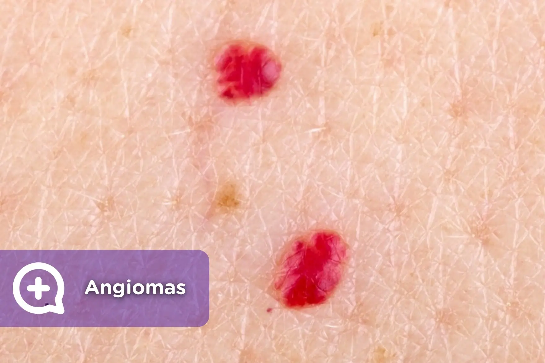 Hemangioma en Adultos: ¿Qué es, Causas, Síntomas y Tratamiento? - Cómo se elimina un hemangioma hemangioma en adultos - Cómo se elimina un hemangioma