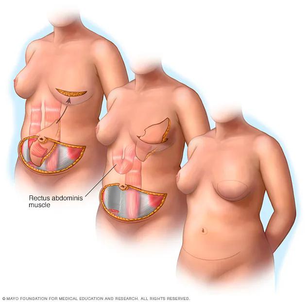 Reconstrucción de mama: Tipos de procedimientos, recuperación y riesgos - Cómo se hace la reconstrucción de seno reconstrucción de mama - Cómo se hace la reconstrucción de seno