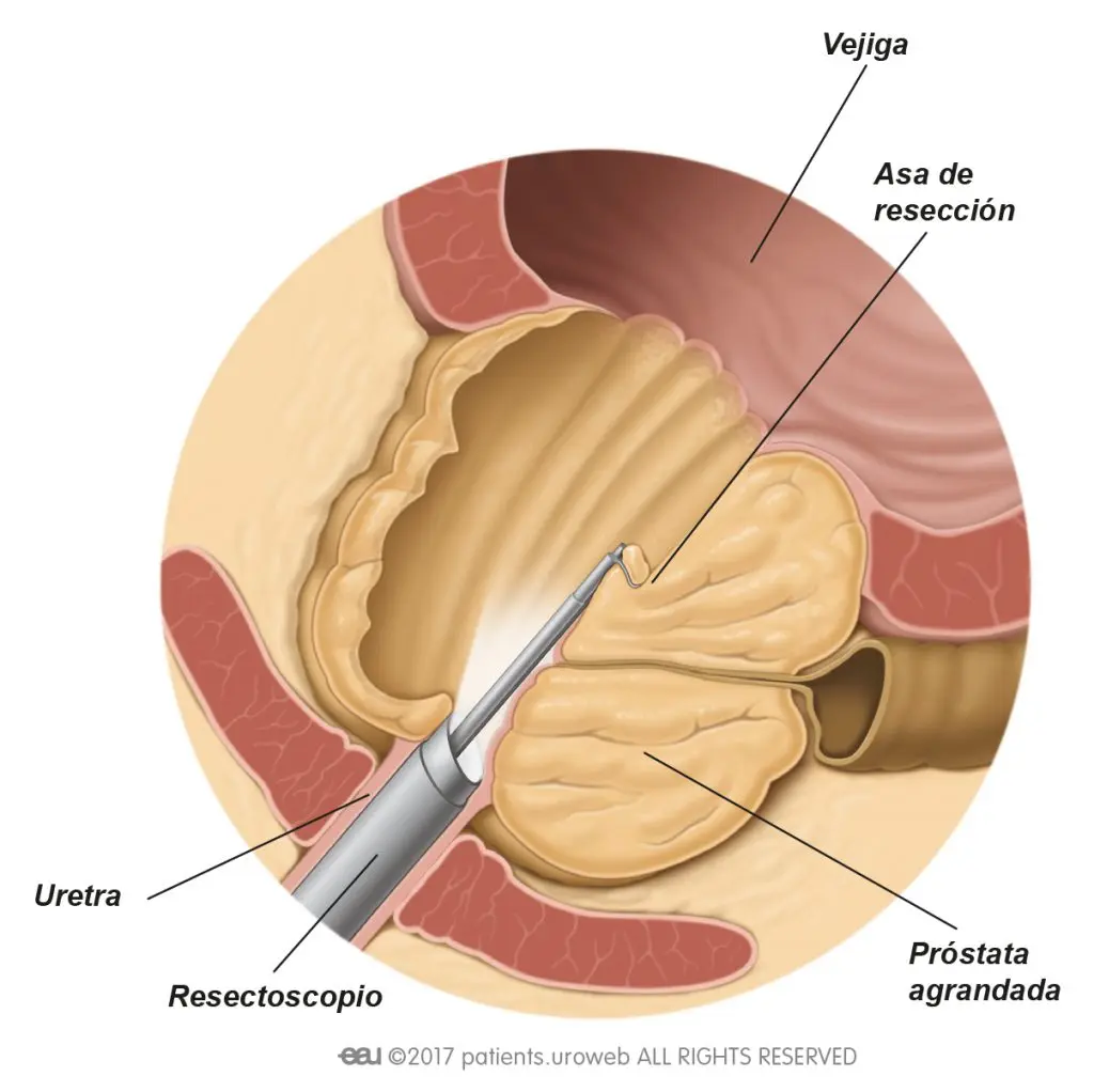 Resección Transuretral de Próstata (RTU): Procedimiento, Riesgos y Recuperación - Cómo se hace una RTU de próstata reseccion transuretral de prostata - Cómo se hace una RTU de próstata