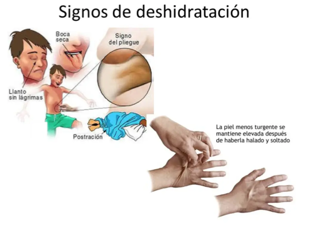 El Signo del Pliegue: Un Indicador de Deshidratación - Cómo se llama el signo de deshidratación signo del pliegue - Cómo se llama el signo de deshidratación