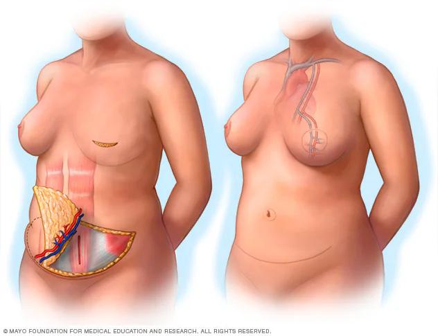 Cirugía de Cáncer de Mama: Tipos, Procedimientos y Reconstrucción - Cómo se llama la cirugía para el cáncer de mama cirugia de cancer de mama - Cómo se llama la cirugía para el cáncer de mama
