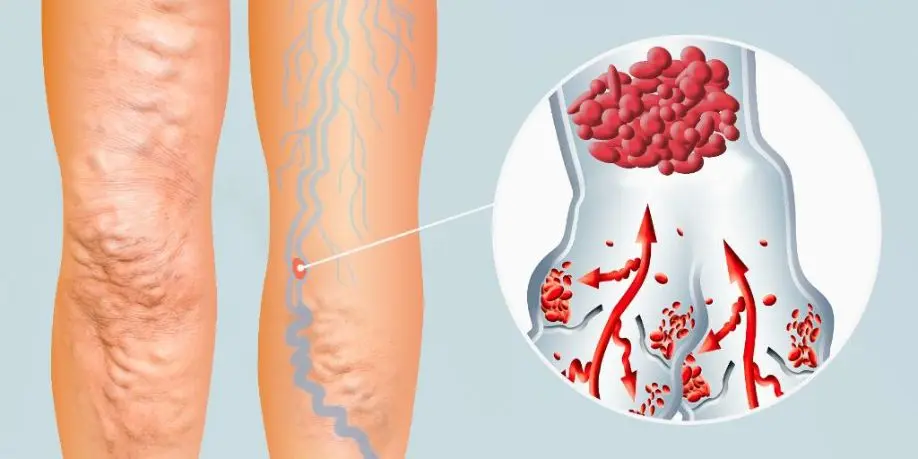 Flebitis: Tratamiento, Causas y Prevención - Cómo se llama la crema para la flebitis flebitis tratamiento - Cómo se llama la crema para la flebitis